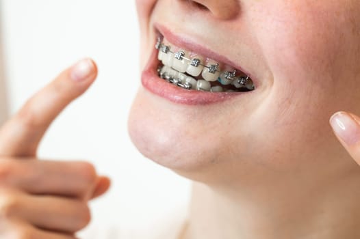 Close-up portrait of a young woman pointing at a smile with braces on her teeth