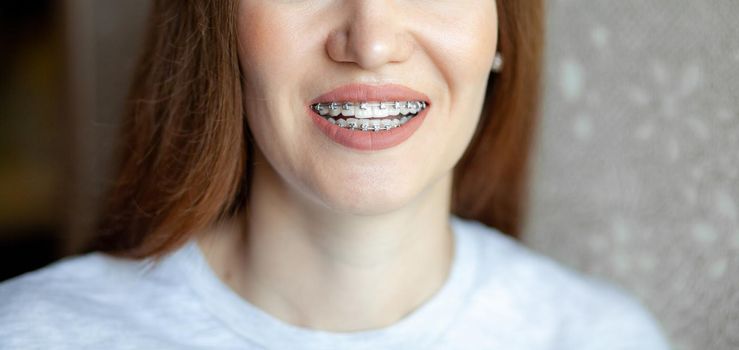 The smile of a young and beautiful girl with braces on her white teeth. Straightening of crooked teeth with the help of a bracket system. Malocclusion. Dental care. Smooth teeth and a beautiful smile