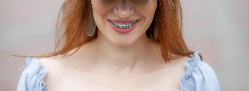 The smile of a young and beautiful girl with braces on her white teeth. Straightening of crooked teeth with the help of a bracket system. Malocclusion. Dental care. Smooth teeth and a beautiful smile