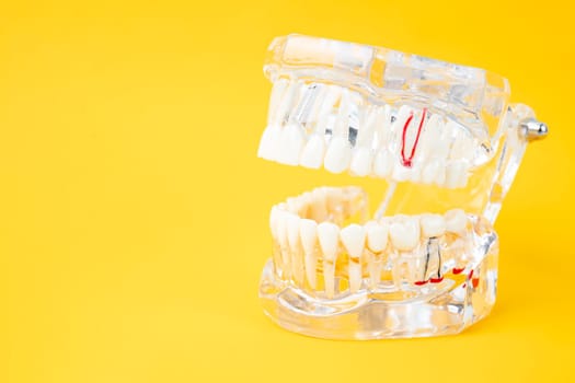 Transparent tooth model with dental implant on yellow background.
