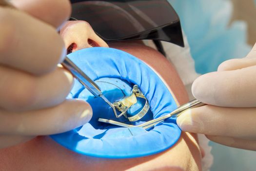 Young woman getting dental treatment at dentist office with a dental rubber dam protection