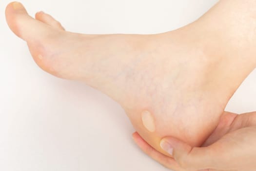 Person Shows Foot with Calluses, Skin Corns on Heel and Phalange of Toe. Water Blister Disease On Feet. Painful Callosity Before Treatment. Closeup Horizontal Plane. Copy Space