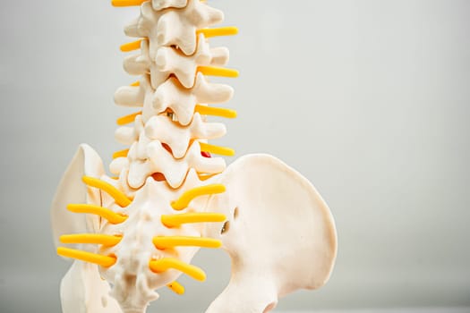 Lumbar spine displaced herniated disc fragment, spinal nerve and bone. Model for treatment medical in the orthopedic department.