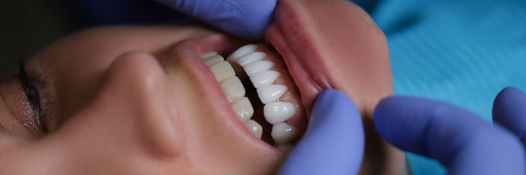 Doctor dentist examining teeth with veneers of female patient in clinic closeup. Dentistry concept