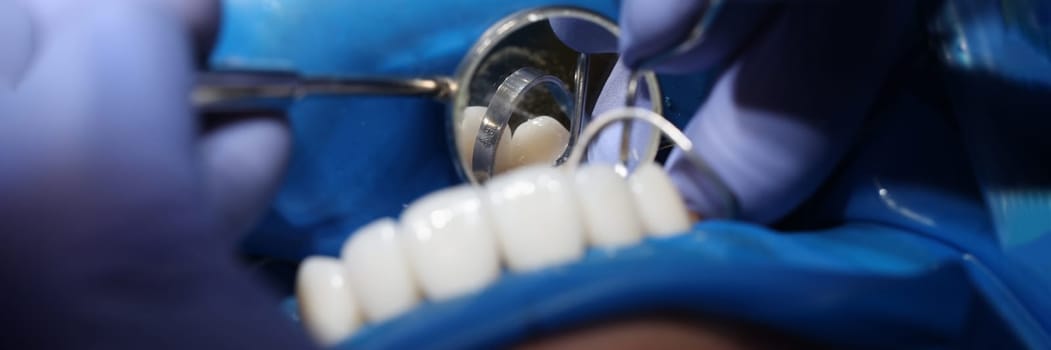 Doctor dentist installing veneers on patient teeth using metal tools closeup. Dental care concept