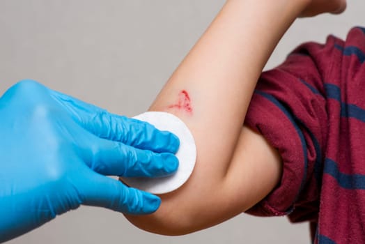 A doctor is cleaning little boy's hand wound in clinic, closeup. A nurse in blue gloves is providing first aid. First aid.