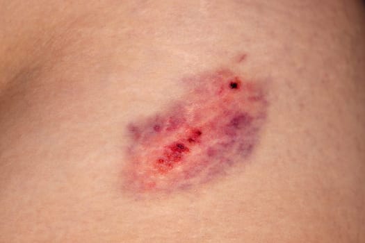 Closeup Bruise on wounded woman leg skin. Domestic violence. Large bruise on the thigh of a woman. Gender violence concept.