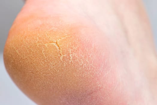 Close up of cracks on the heels. A persons heel with dry skin and cracks.