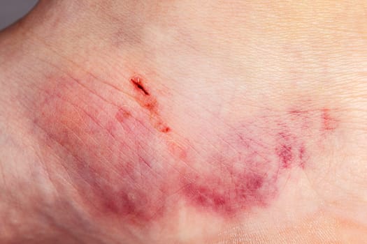 Close-up on the bruise on the skin of the leg of an injured woman. Close up on a bruise on the skin of an injured woman's leg. Gender Violence Concept.
