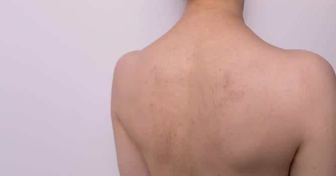 Closeup Bruises, Broken Capillaries After Cupping, Anti Cellulite Massage Procedure On Patient's Back. Feeling Bad, Effect, Consequences After Massage. Complications. Copy Space. Horizontal Plane