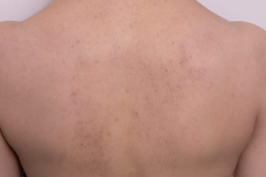 Close up bruises, broken capillaries after cupping, anti cellulite massage procedure on female back. Feeling unwell, Bad Effect, consequences after massage. Complications. Horizontal Plane.