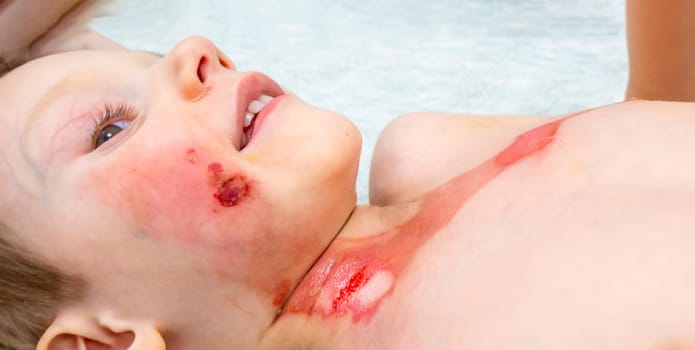 medical procedure dressing a boy with a first-degree burn from boiling water on his face, neck and chest