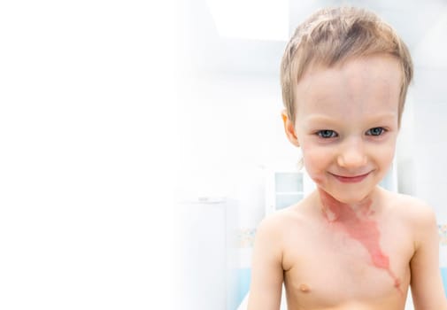 medical procedure dressing a boy with a first-degree burn from boiling water on his face, neck and chest