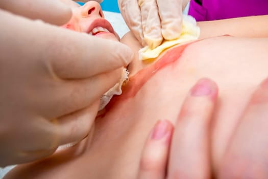 medical procedure dressing a boy with a first-degree burn from boiling water on his face, neck and chest