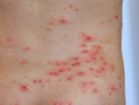 Closeup of Chicken pox rash - Viral infections disease Varicella