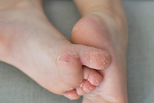 Enterovirus foot hand mouth disease Skin peeled off on the legs of a child Cocksackie virus