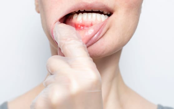 Closeup aphthous stomatitis on gum. Doctor checks small ulcer in woman's mouth. Physician's hand in glove pulls female Caucasian's lip, white background. Diagnosis and treatment concept. Horizontal.