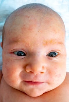 baby allergy skin. child dermatitis symptom problem rash. suffering atopic symptom on skin cheeks. concept child health. allergic reaction miliaria, prickly heat on baby's back.