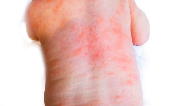 baby allergy skin. child dermatitis symptom problem rash. suffering atopic symptom on skin cheeks. concept child health. allergic reaction miliaria, prickly heat on baby's back.