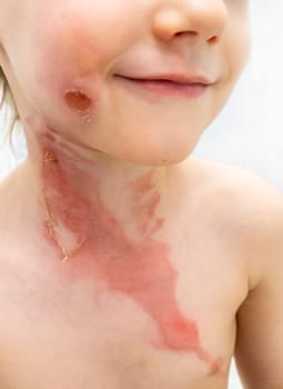 medical procedure dressing a boy with a first-degree burn from boiling water on his face, neck and chest