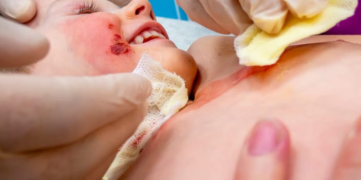 medical procedure dressing a boy with a first-degree burn from boiling water on his face, neck and chest