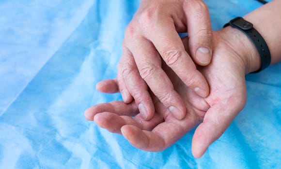 Psoriasis on the hands of a man. Dry male hand on a blue background. Hike to the doctor, treatment of eczema and psoriasis