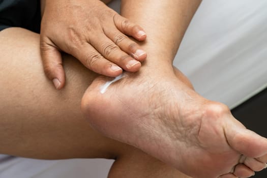 Woman care feet with cracked and dry heel skin cream at home.