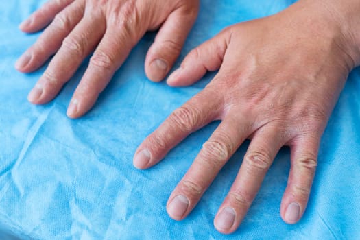 Psoriasis on the hands of a man. Dry male hand on a blue background. Hike to the doctor, treatment of eczema and psoriasis