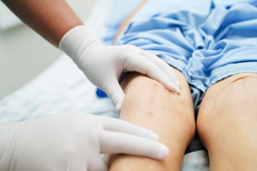 Doctor checking Asian elderly woman patient with scar knee replacement surgery in hospital.