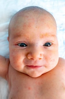 baby allergy skin. child dermatitis symptom problem rash. suffering atopic symptom on skin cheeks. concept child health. allergic reaction miliaria, prickly heat on baby's back.