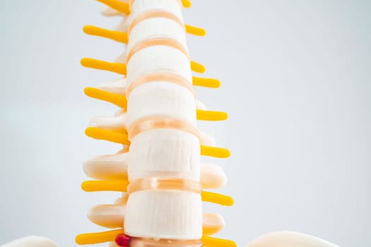 Lumbar spine displaced herniated disc fragment, spinal nerve and bone. Model for treatment medical in the orthopedic department.