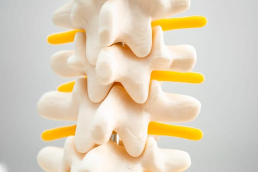 Lumbar spine displaced herniated disc fragment, spinal nerve and bone. Model for treatment medical in the orthopedic department.