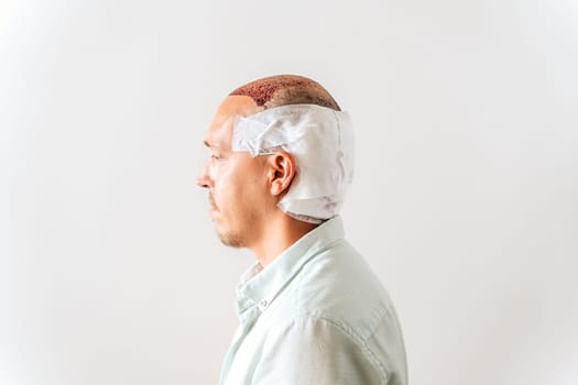 After hair transplantation surgical technique that moves hair follicles. Young bald man in bandage with hair loss problems. White background with copy space.