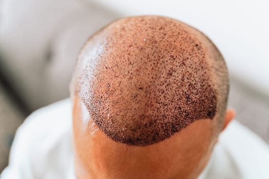 After hair transplantation surgical technique that moves hair follicles. Young bald man with hair loss problems.