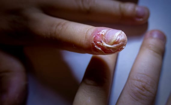 finger swollen with inflammation due to Nail ripped infection children's hands with a tear near the nail of the index finger. the consequence of biting your nails.