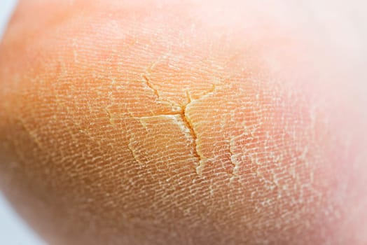 Cracked heel. Close up of a person with dry skin on heel.