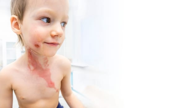 medical procedure dressing a boy with a first-degree burn from boiling water on his face, neck and chest