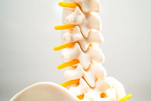 Lumbar spine displaced herniated disc fragment, spinal nerve and bone. Model for treatment medical in the orthopedic department.