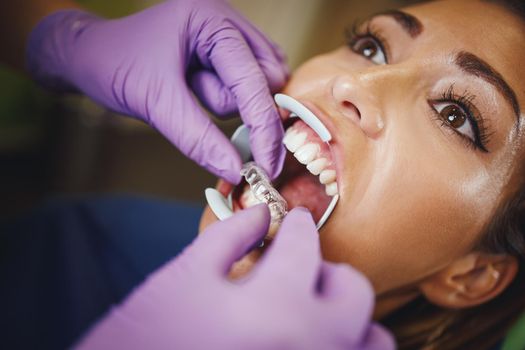 Cropped shot of a dentist sets invisible dental aligner on teeth of a young woman. He is putting invisalign removable braces.