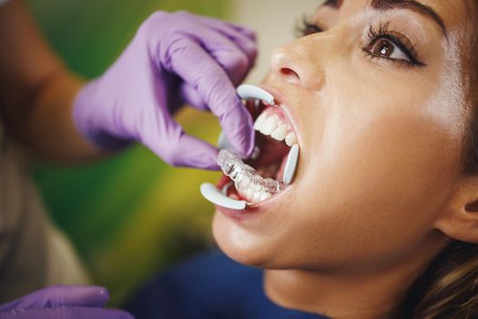 Cropped shot of a dentist sets invisible dental aligner on teeth of a young woman. He is putting invisalign removable braces.