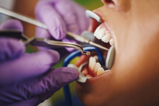 Cropped shot of a beautiful young woman is at the dentist. She sits in the dentist's chair and the dentist sets braces on her teeth putting aesthetic self-aligning lingual locks.