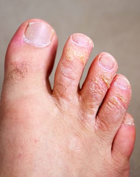 neglected toes, fungus and calluses on the fingers, close-up calloused toes,