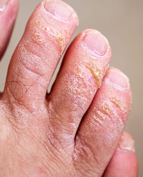 neglected toes, fungus and calluses on the fingers, close-up calloused toes,