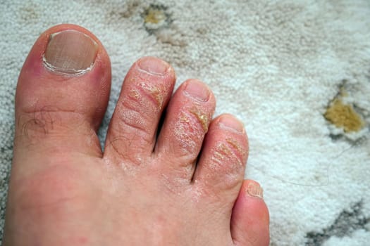 neglected toes, fungus and calluses on the fingers, close-up calloused toes,
