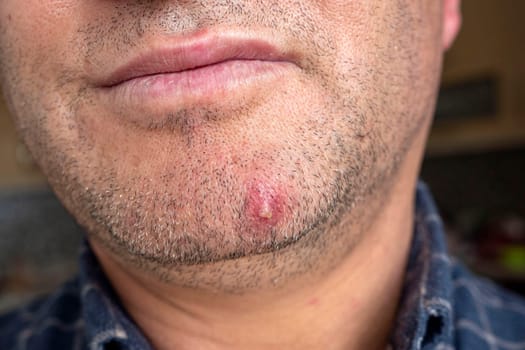 inflamed acne on the facial skin of a person, single large acne on the face,