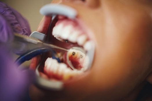 Cropped shot of a beautiful young woman is at the dentist. She sits in the dentist's chair and the dentist check aesthetic self-aligning lingual locks on her teeth putting.