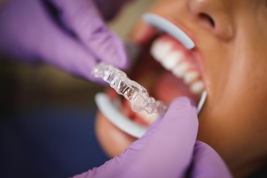 Cropped shot of a dentist sets invisible dental aligner on teeth of a young woman. He is putting invisalign removable braces.