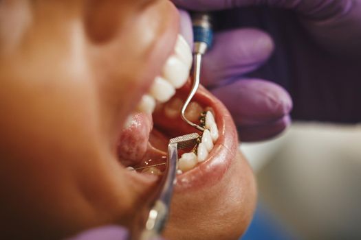 Cropped shot of a beautiful young woman is at the dentist. She sits in the dentist's chair and the dentist sets braces on her teeth putting aesthetic self-aligning lingual locks.