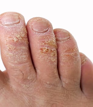 close-up of a man's toes with fungal disease, skin cracking and callus formation on his toes,