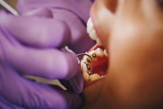 Cropped shot of a beautiful young woman is at the dentist. She sits in the dentist's chair and the dentist sets braces on her teeth putting aesthetic self-aligning lingual locks.